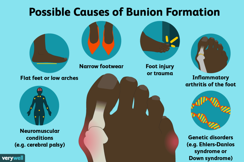 bunion causes