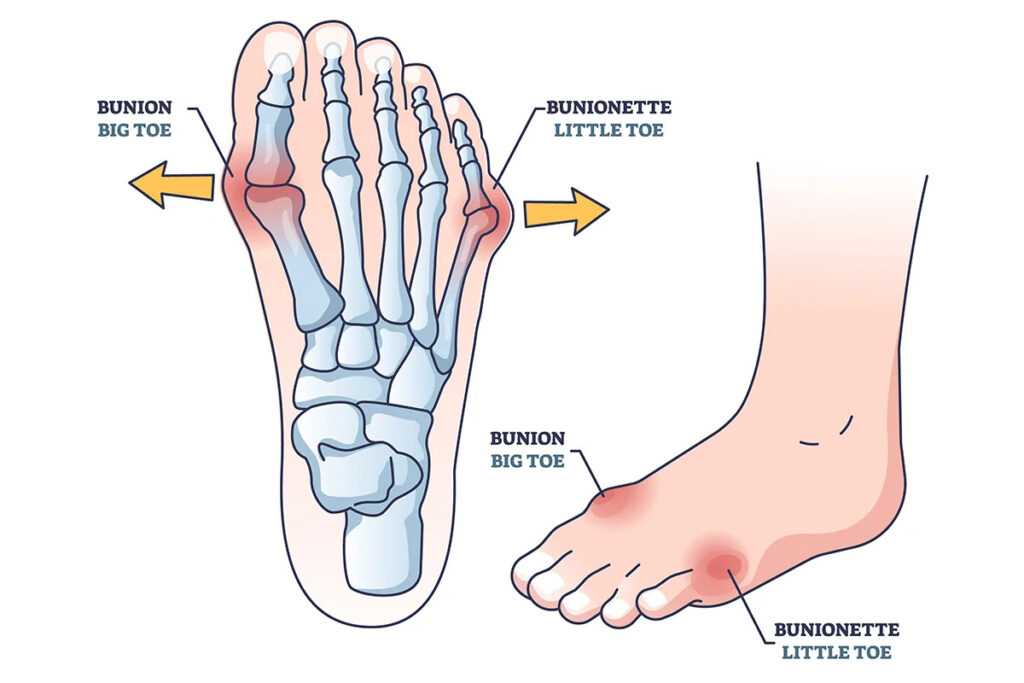 bunions