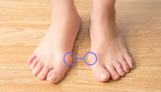 Are Bunions Genetic? A Simple Answer with Scientific Facts