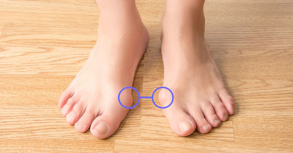 are bunions genetic